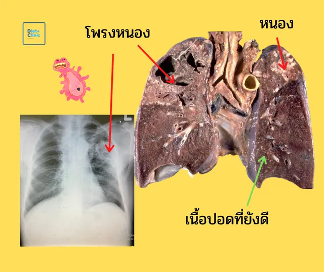 วัณโรคปอด