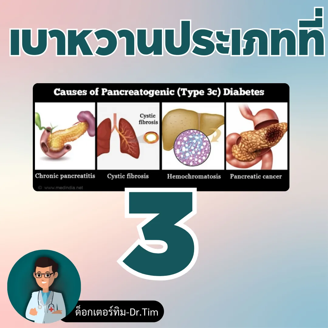 เบาหวานประเภท 3